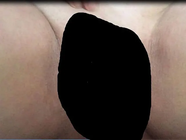 Dilator 18 mm