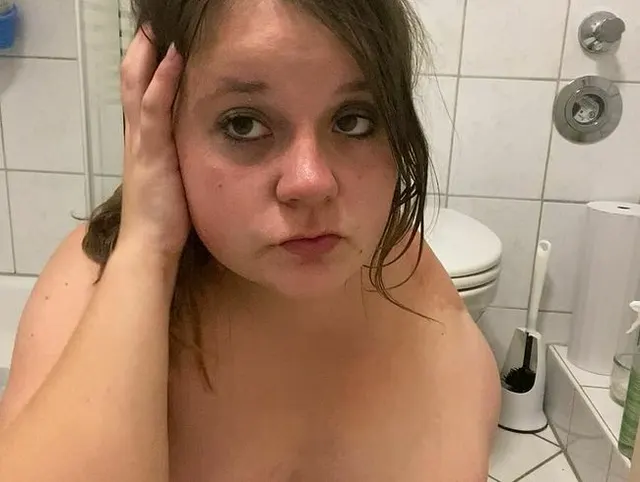 Meine Narben brauchen Pflege! Creme mich ein!